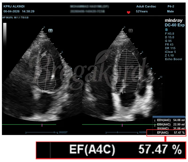 Hasil echocardiography setelah terapi, EF 57,47%