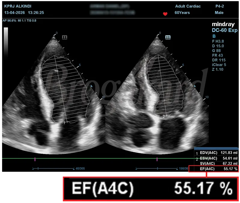 Hasil echocardiography setelah terapi, EF 55,17%