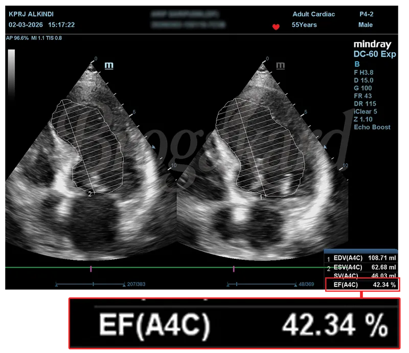 Hasil echocardiography sebelum terapi, EF 42,34%