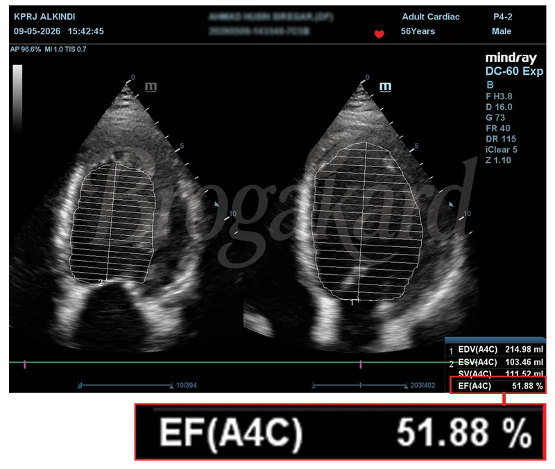 Hasil echocardiography setelah terapi, EF 51,88%